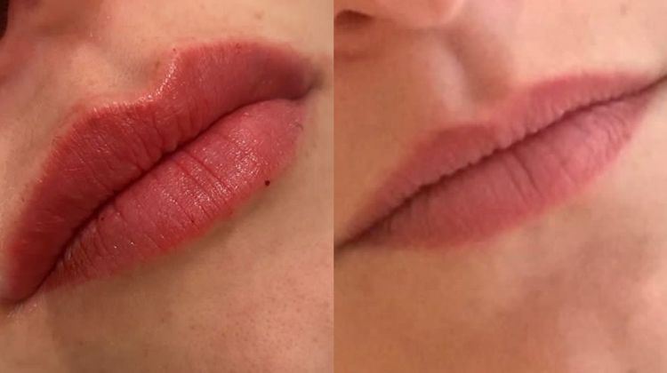 תוצאות טיפול למילוי שפתיים (צילום: יחצ ביוטי קליניק)